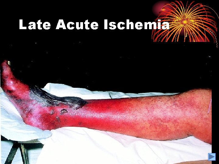 Figure 2. 8 Late Acute Ischemia 