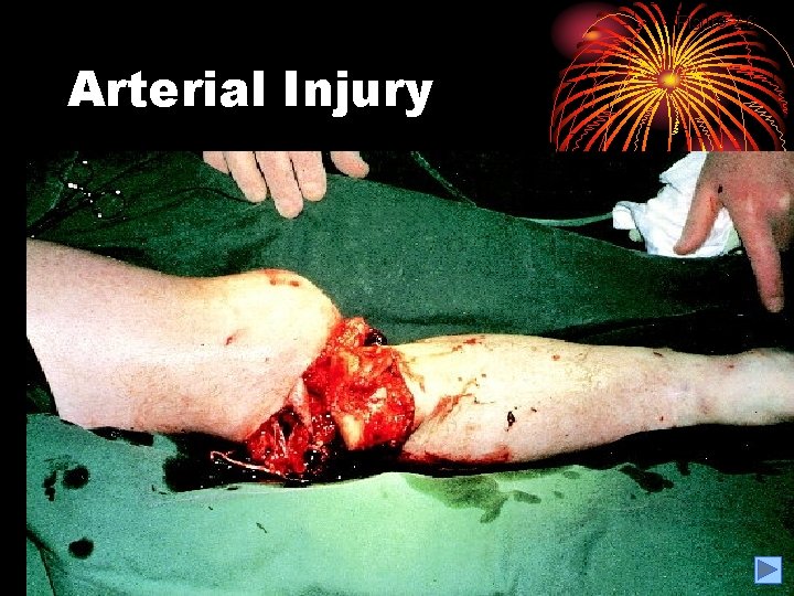 Figure 2. 6 Arterial Injury 