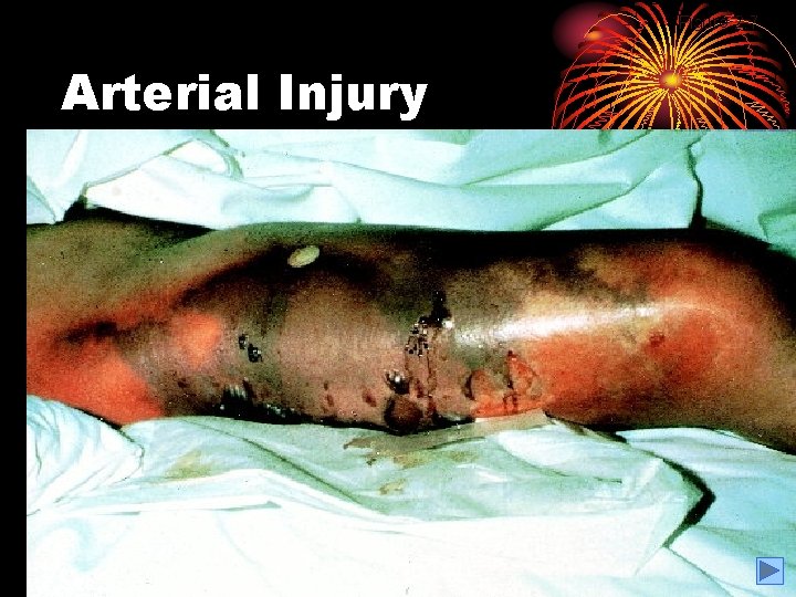 Figure 2. 7 Arterial Injury 