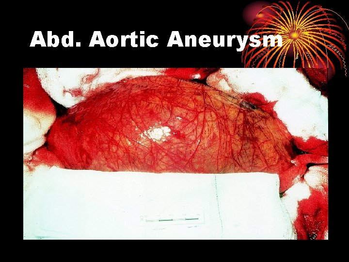 Abd. Aortic Aneurysm 