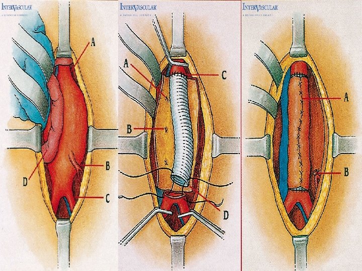 Figure 8. 6 • Surgical ttt 