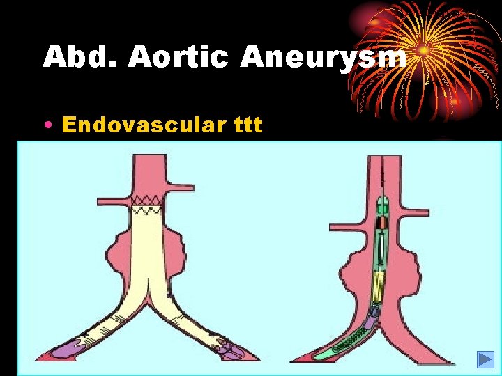 Figure 8. 7 Abd. Aortic Aneurysm • Endovascular ttt 