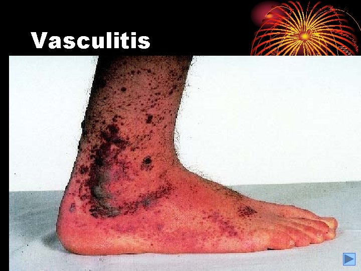 Figure 10. 6 Vasculitis 