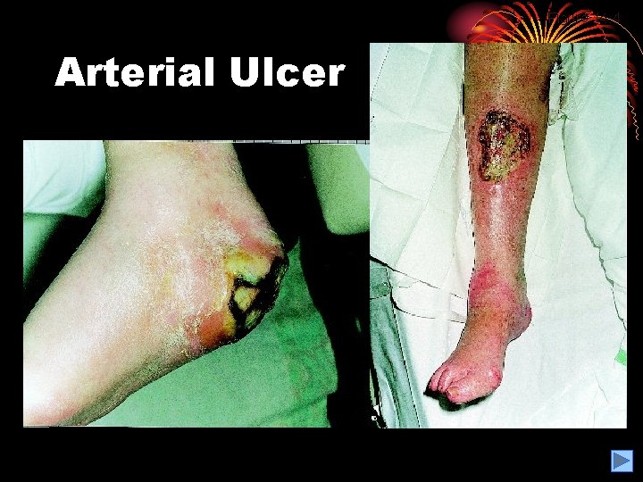 Figure 14. 4 Arterial Ulcer 
