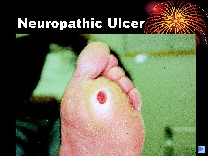 Figure 14. 3 Neuropathic Ulcer 