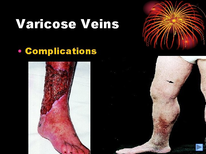 Figure 11. 5 Varicose Veins • Complications 