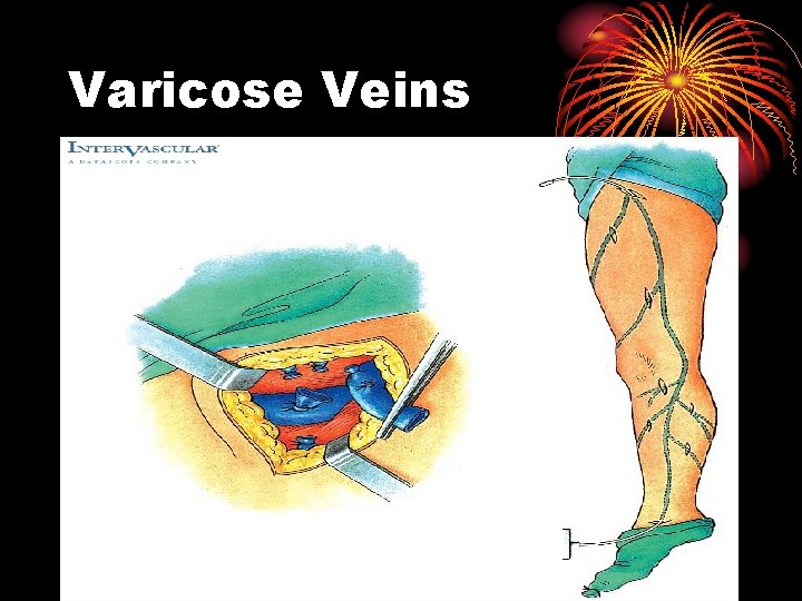 Varicose Veins 