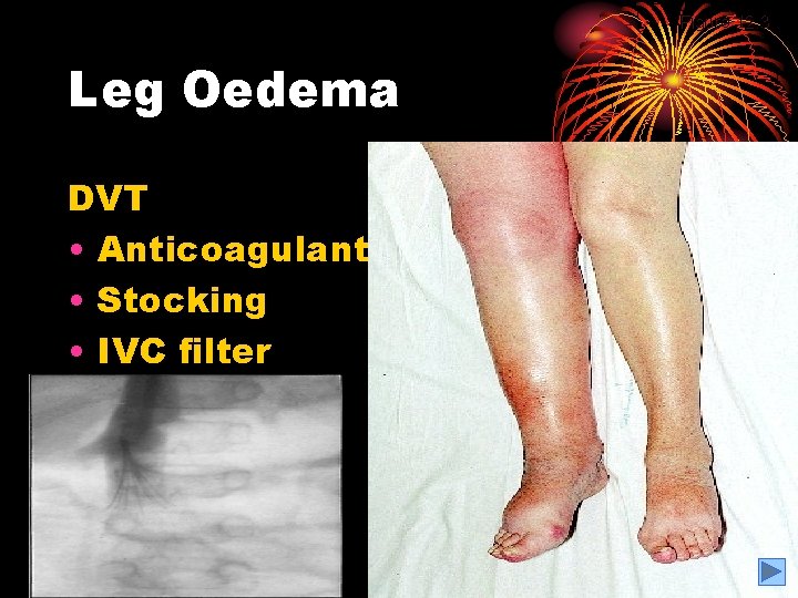 Figure 12. 3 Leg Oedema DVT • Anticoagulant • Stocking • IVC filter 