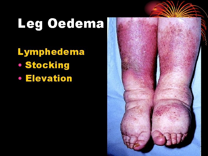 Leg Oedema Lymphedema • Stocking • Elevation 