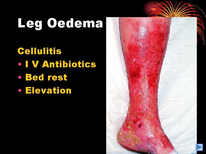 Figure 11. 6 Leg Oedema Cellulitis • I V Antibiotics • Bed rest •