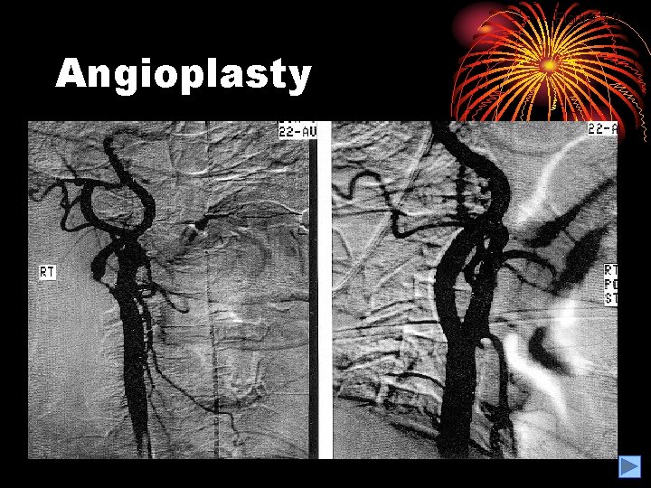 Figure 5. 9 Angioplasty 