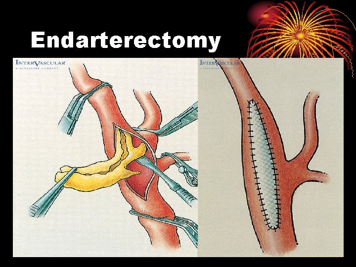 Endarterectomy 