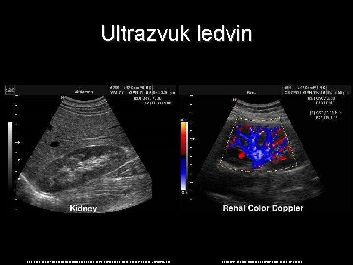 Ultrazvuk ledvin http: //lunar. thegamez. net/medical/ultrasound-sonography/ru-ultrasound-image-description-kidney-640 x 480. jpg http: //www. genesis-ultrasound. com/images/renal-ul-image. jpg
