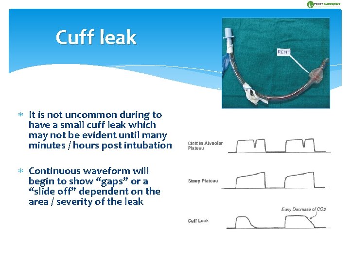 Cuff leak It is not uncommon during to have a small cuff leak which
