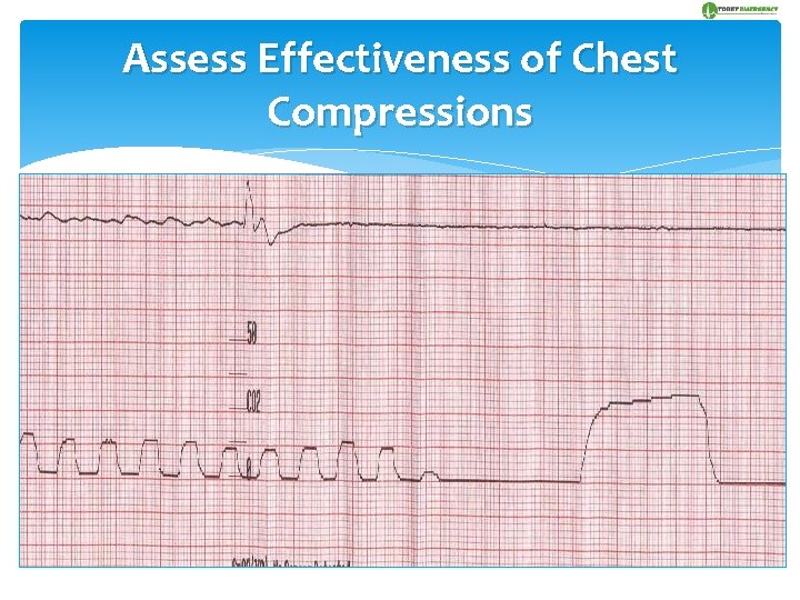 Assess Effectiveness of Chest Compressions With constant ventilation, non-invasive capnography correlates with the blood