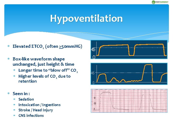 Hypoventilation Elevated ETCO 2 (often >50 mm. HG) Box-like waveform shape unchanged, just height