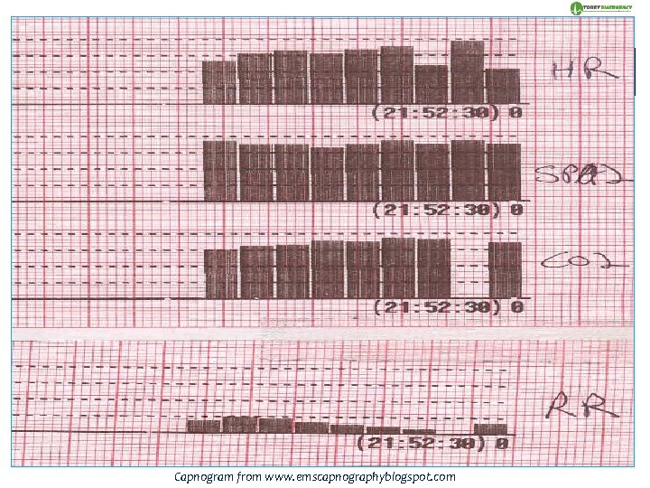 OXYGENTATION O 2 bloodstream to cells Non-invasive measurement by pulse oximetry (Sp. O 2)