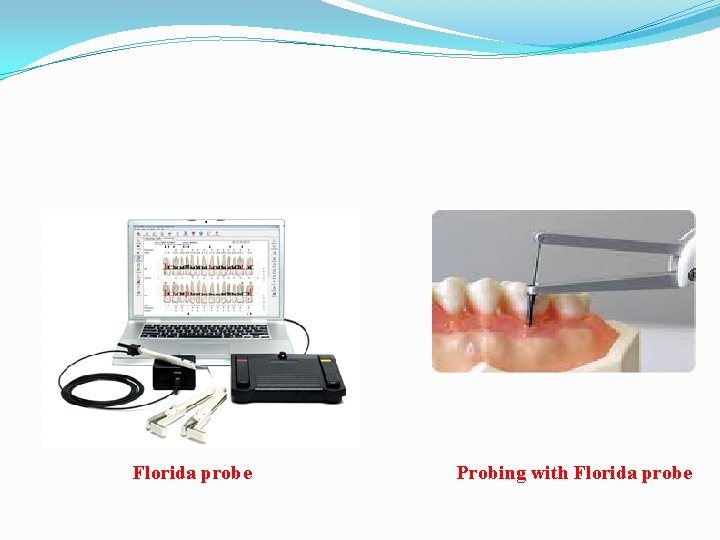 Florida probe Probing with Florida probe 