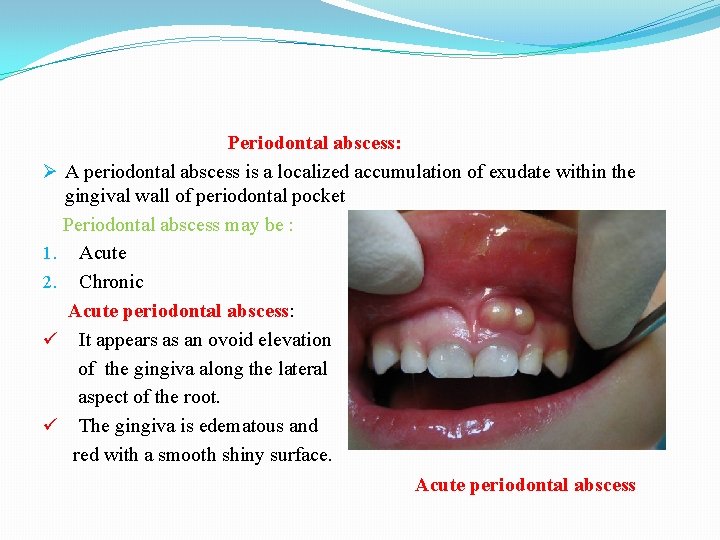 Periodontal abscess: Ø A periodontal abscess is a localized accumulation of exudate within the
