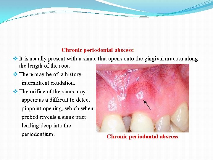 Chronic periodontal abscess: v It is usually present with a sinus, that opens onto