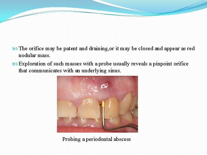  The orifice may be patent and draining, or it may be closed and