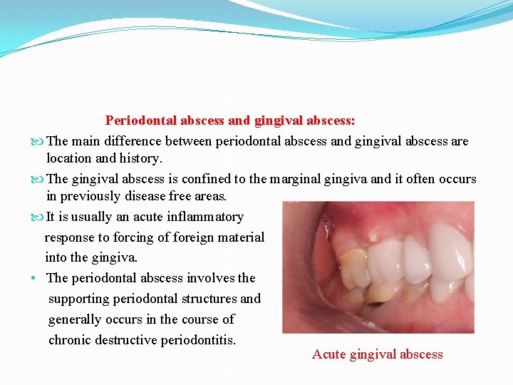 Periodontal abscess and gingival abscess: The main difference between periodontal abscess and gingival abscess