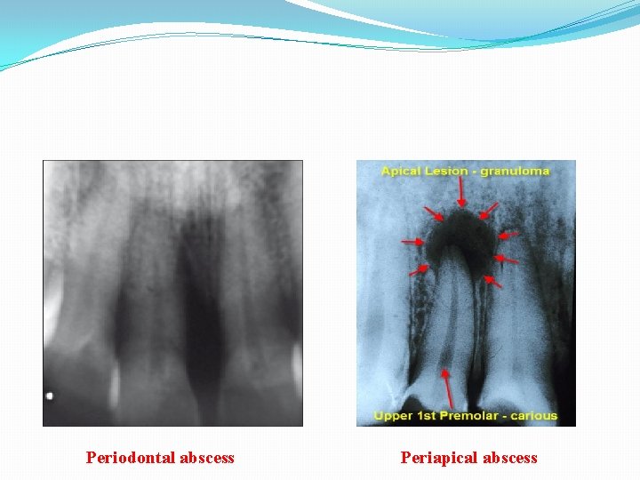 Periodontal abscess Periapical abscess 