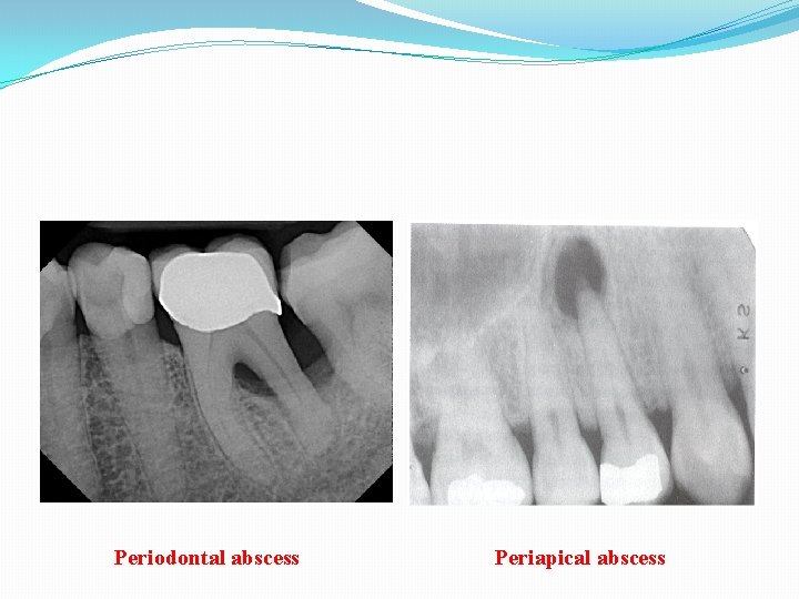 Periodontal abscess Periapical abscess 