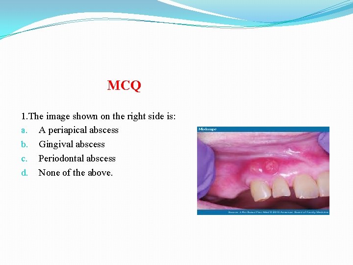 MCQ 1. The image shown on the right side is: a. A periapical abscess