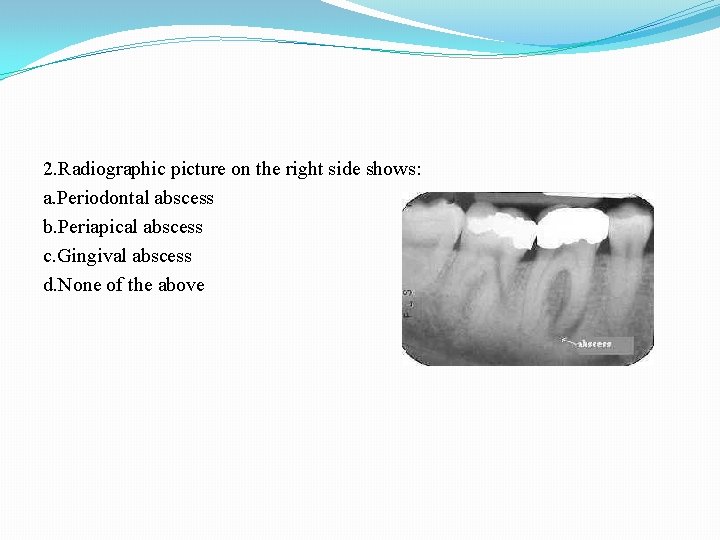 2. Radiographic picture on the right side shows: a. Periodontal abscess b. Periapical abscess