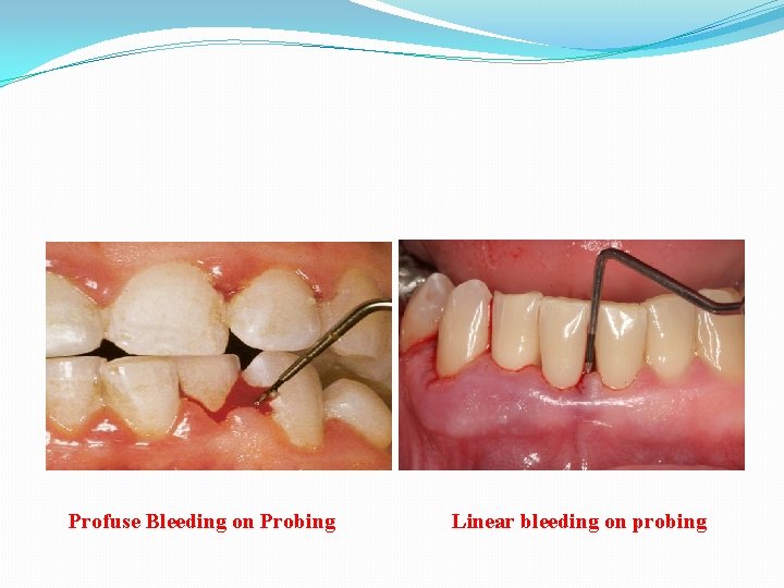 Profuse Bleeding on Probing Linear bleeding on probing 