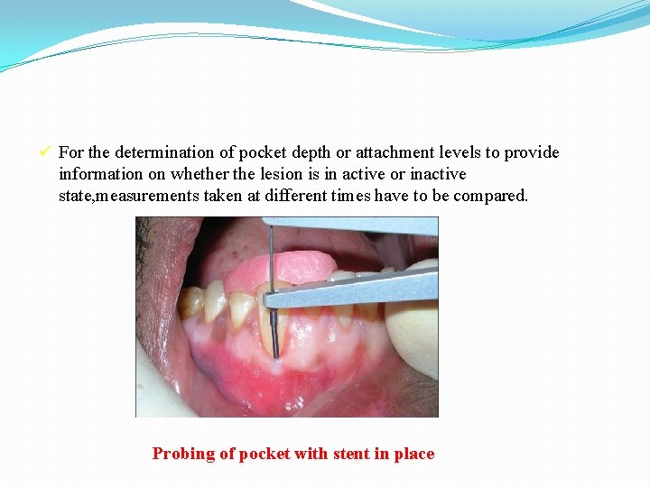 ü For the determination of pocket depth or attachment levels to provide information on