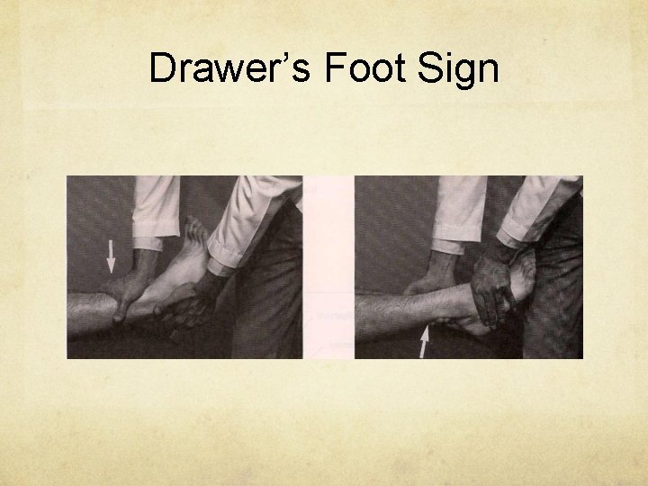 Drawer’s Foot Sign 