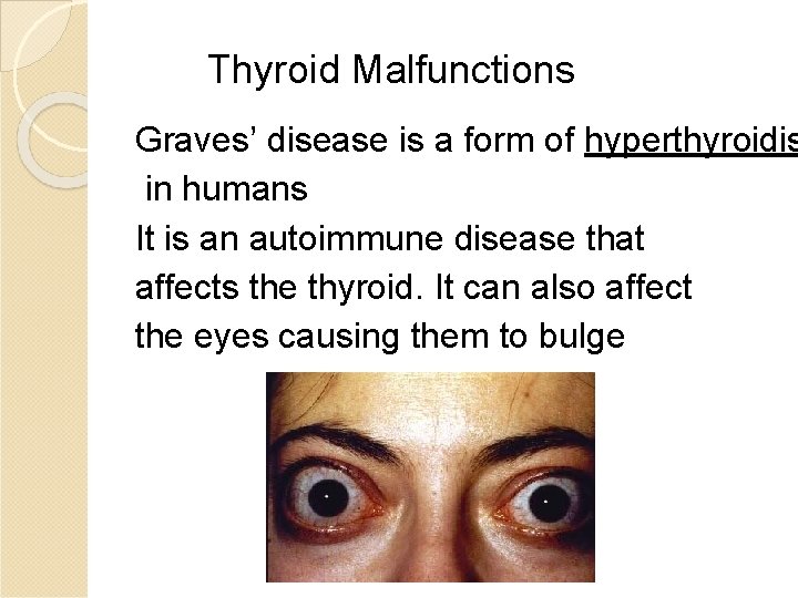 Thyroid Malfunctions Graves’ disease is a form of hyperthyroidis in humans It is an