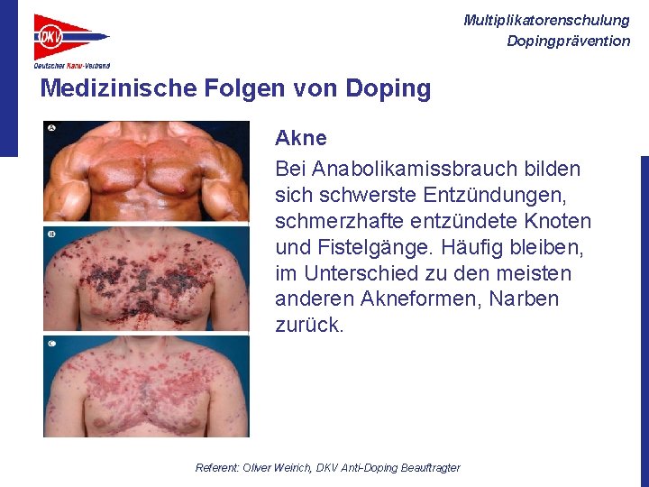 Multiplikatorenschulung Dopingprävention Medizinische Folgen von Doping Akne Bei Anabolikamissbrauch bilden sich schwerste Entzündungen, schmerzhafte