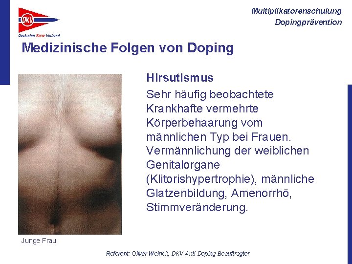 Multiplikatorenschulung Dopingprävention Medizinische Folgen von Doping Hirsutismus Sehr häufig beobachtete Krankhafte vermehrte Körperbehaarung vom