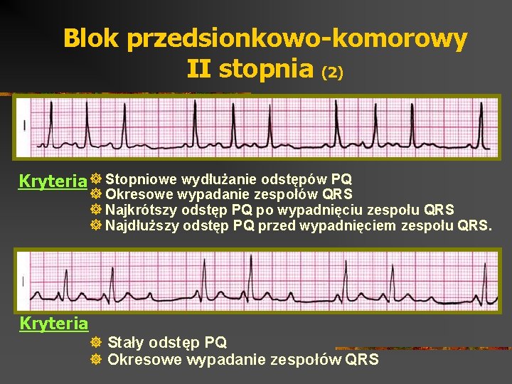 Blok przedsionkowo-komorowy II stopnia (2) Kryteria ] Stopniowe wydłużanie odstępów PQ ] Okresowe wypadanie