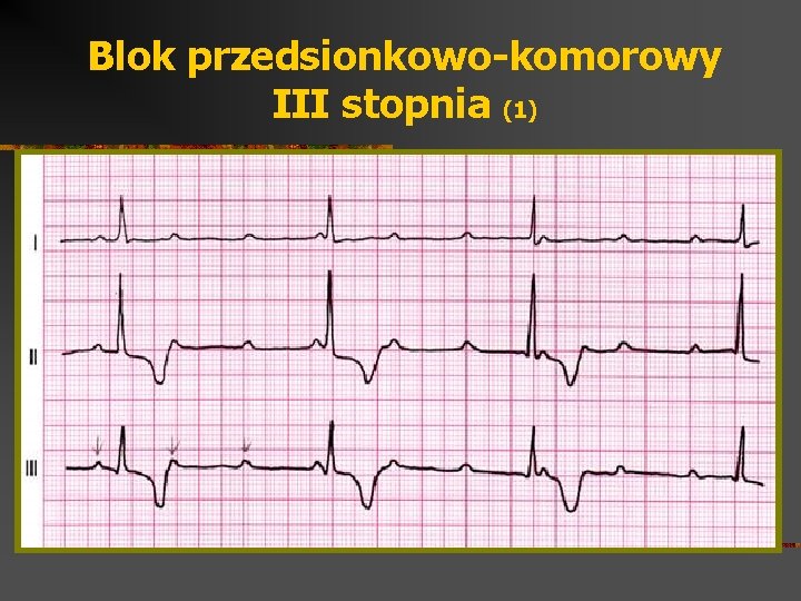 Blok przedsionkowo-komorowy III stopnia (1) 