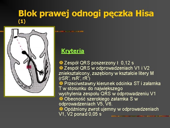 Blok prawej odnogi pęczka Hisa (1) Kryteria ] Zespół QRS poszerzony ł 0, 12