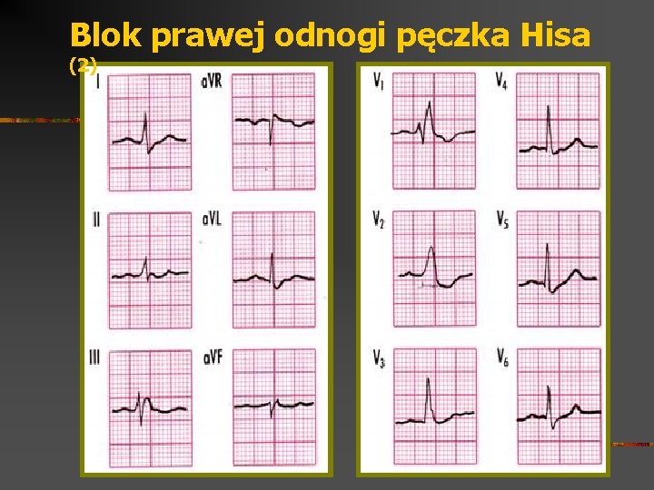 Blok prawej odnogi pęczka Hisa (2) 