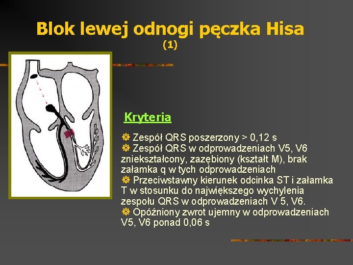 Blok lewej odnogi pęczka Hisa (1) Kryteria ] Zespół QRS poszerzony > 0, 12