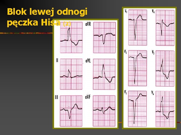 Blok lewej odnogi pęczka Hisa (2) 