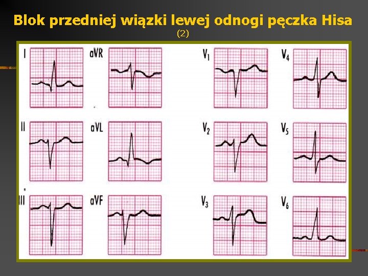 Blok przedniej wiązki lewej odnogi pęczka Hisa (2) 