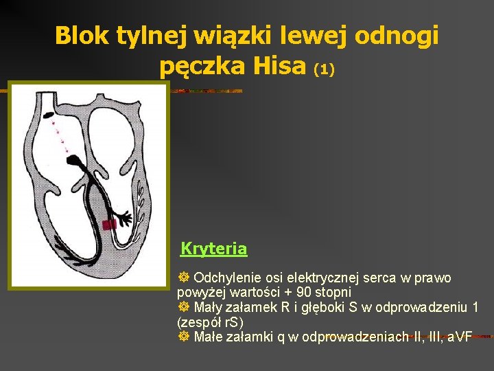 Blok Tylnej Wiązki Lewej Odnogi Pęczka Hisa slidetodoc.com