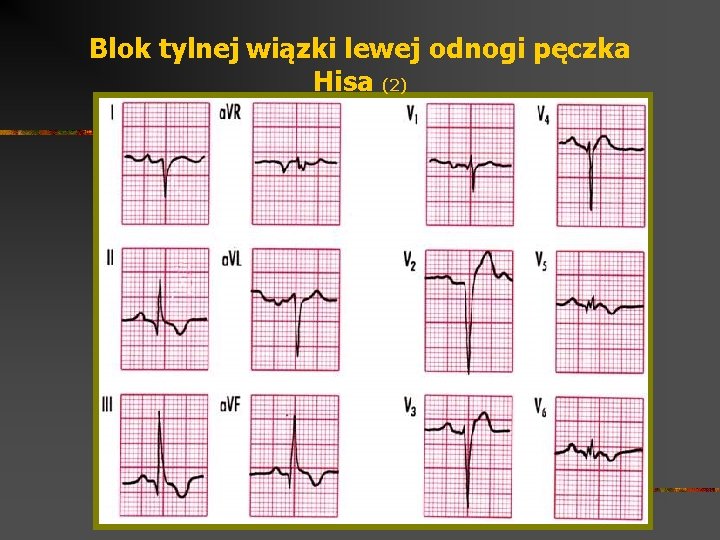 Blok tylnej wiązki lewej odnogi pęczka Hisa (2) 