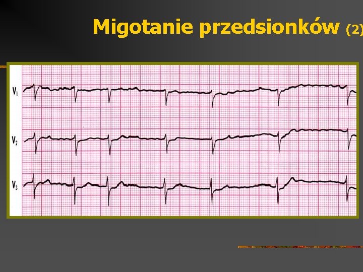 Migotanie przedsionków (2) 