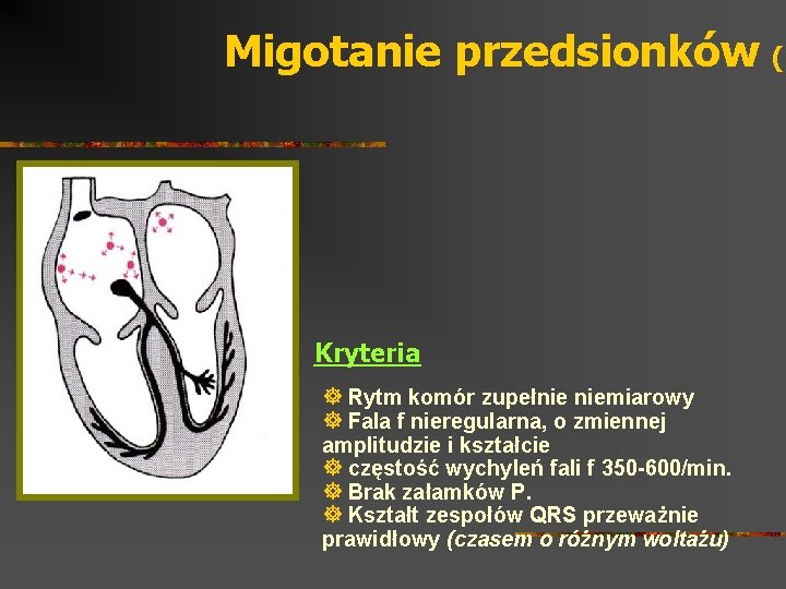 Migotanie przedsionków Kryteria ] Rytm komór zupełnie niemiarowy ] Fala f nieregularna, o zmiennej