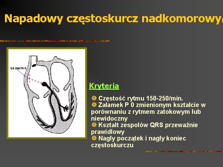 Napadowy częstoskurcz nadkomorowy( Kryteria ] Częstość rytmu 150 -250/min. ] Załamek P 0 zmienionym