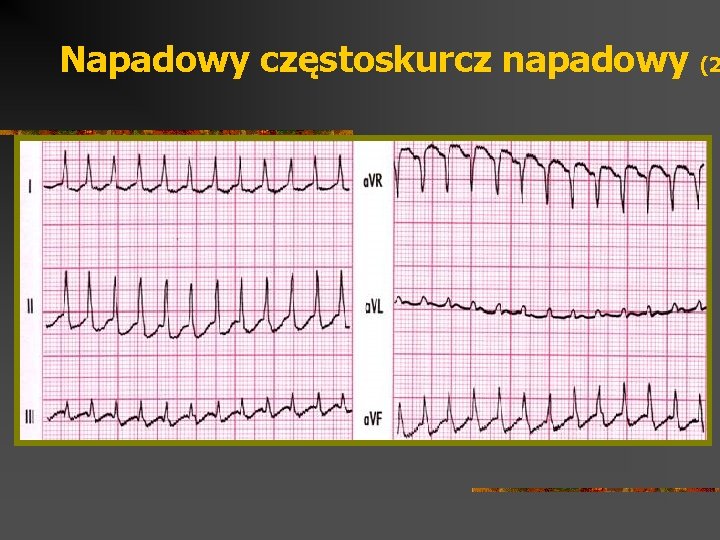 Napadowy częstoskurcz napadowy (2 