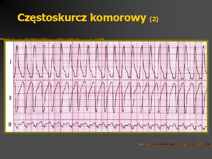 Częstoskurcz komorowy (2) 